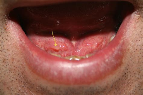 舌 下 腺 炎